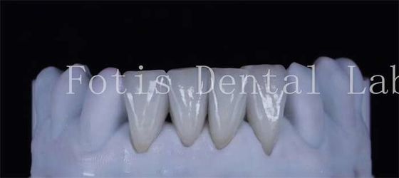 أسنان رقيقة مصنوعة من الملمع القماشية 0.3-0.5mm سميكة جميلة