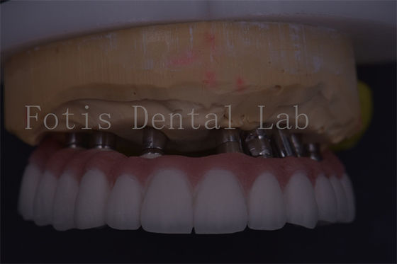 تاج أسنان فضي قابل للتخصيص