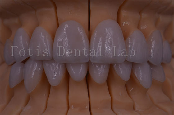 FDA/ISO/CE معتمدة التاج الرقمي الأسنان التاج الاصطناعي أي حجم