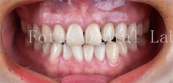 طب الأسنان التجميلي القشرة البورسلينية الأسنان مع مقاومة عالية للبقع