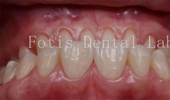 0.3-0.5mm سمك الأسنان التجميلية تغطي القشرة لطب الأسنان التجميلية