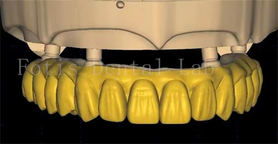 تصميم تاج الأسنان المصنعين يستخدم تكنولوجيا الفحص المتقدمة والطباعة ثلاثية الأبعاد
