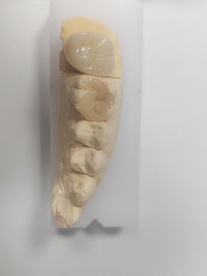 طب الأسنان المزروعة والملصقة لملء الغير مباشر واستعادة لون الأسنان