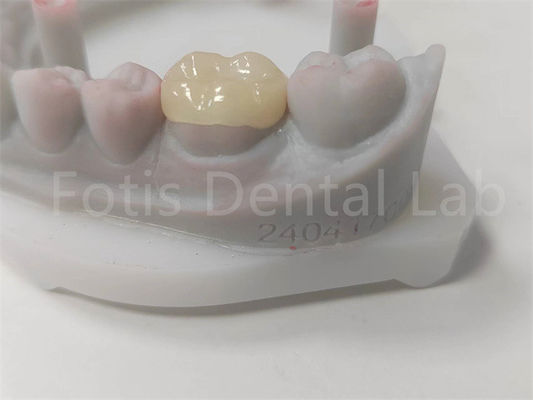 OEM طب الأسنان الإدراج والإستعادة السيراميكية Onlay وملء الأسنان الملونة